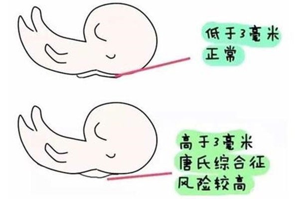 患有多囊卵巢综合症的海外试管婴儿的治疗方案