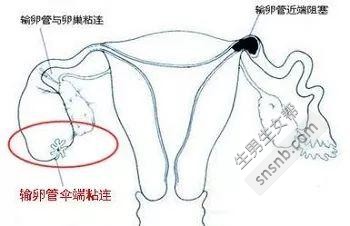 不符合条件的试管婴儿的主要适应症有哪些？影响试管婴儿成功率的三种最重要的疾病。