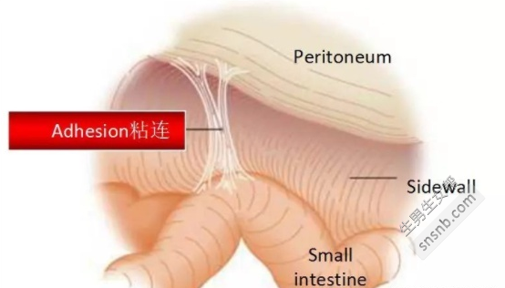 如果我在试管婴儿周期中发现宫腔粘连，应该怎么办？