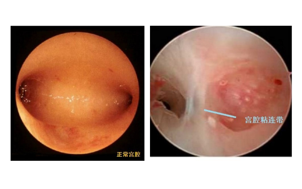 宫腔粘连会影响备孕吗？