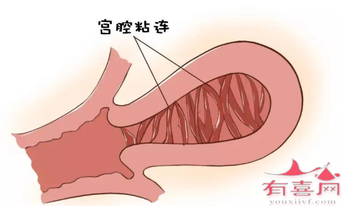 宫腔粘连会自行恢复吗？