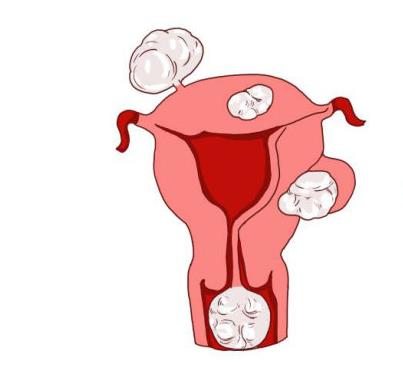 石家庄50岁试管助孕-多年不孕后有子宫肌瘤，可以做试管婴儿吗？